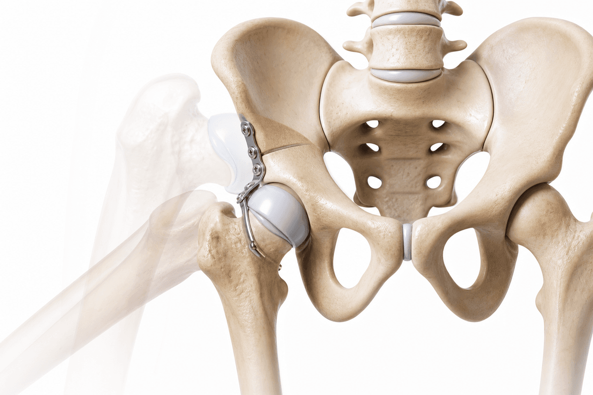Hip Reconstruction