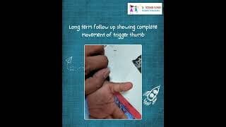 Congenital Trigger Thumb Treatment Journey