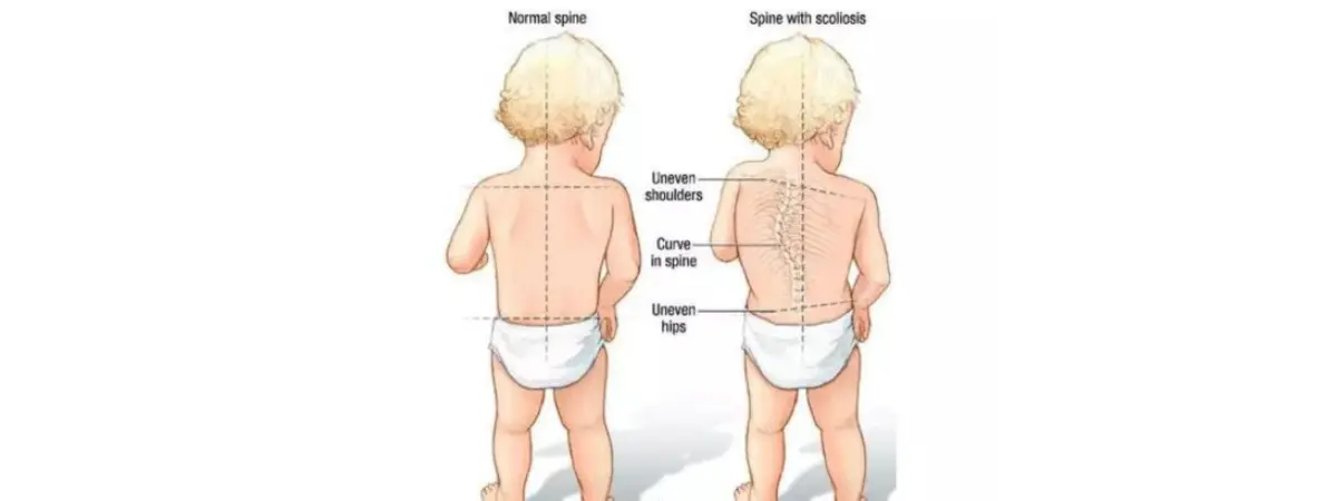 spinal-arthritis-blog