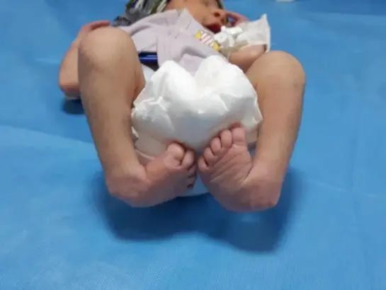 Clubfoot/Flatfoot Treatment