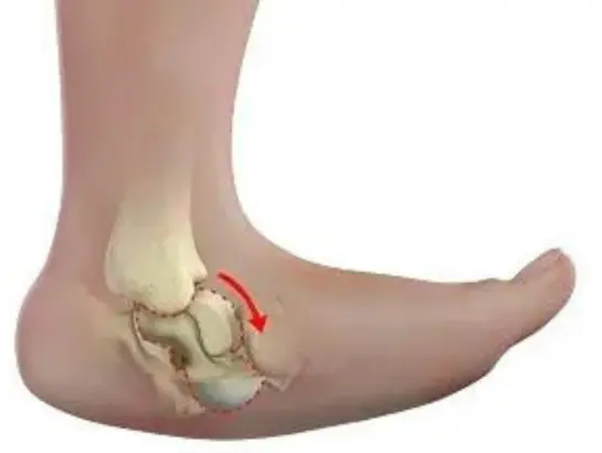 Congenital Vertical Talus Treatment