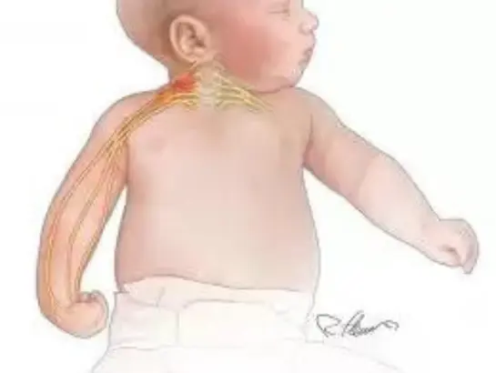 Erb's Palsy Treatment