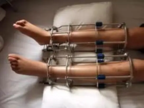 Limb Lengthening Treatment
