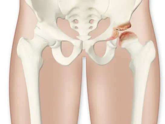 Perthes Disease Treatment