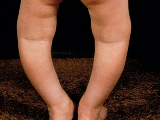 Rickets Treatment
