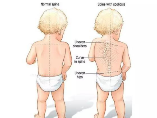 Scoliosis Treatment