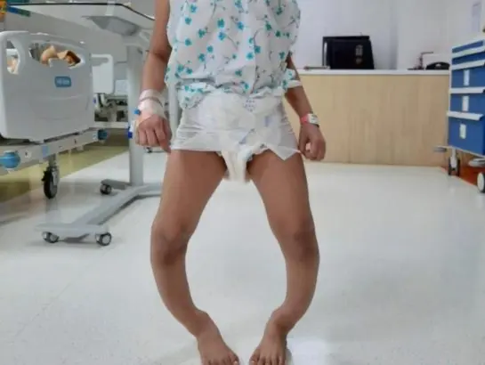 equinus-deformity-treatment-near-secunderabad