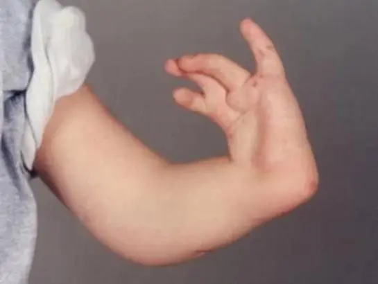 radial-clubhand-treatment-near-secunderabad