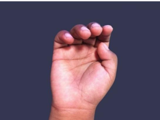 trigger-thumb-treatment-near-secunderabad