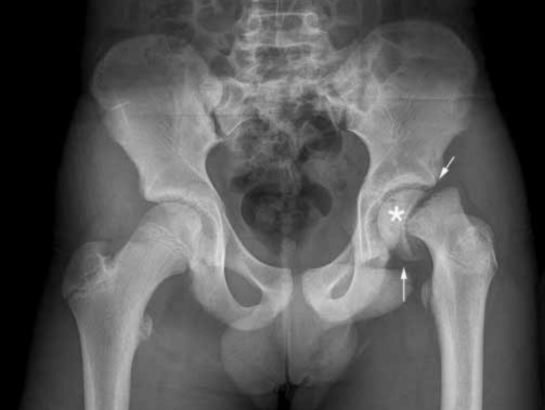 Slipped Capital Femoral Epiphysis Treatment